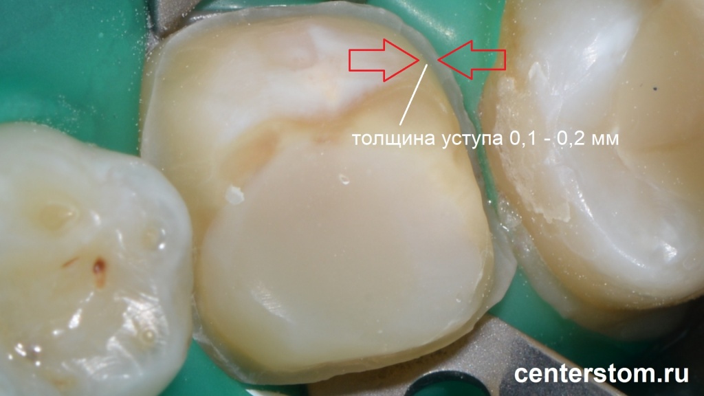 Микроинвазивное препарирование зуба проводится в пределах эмали