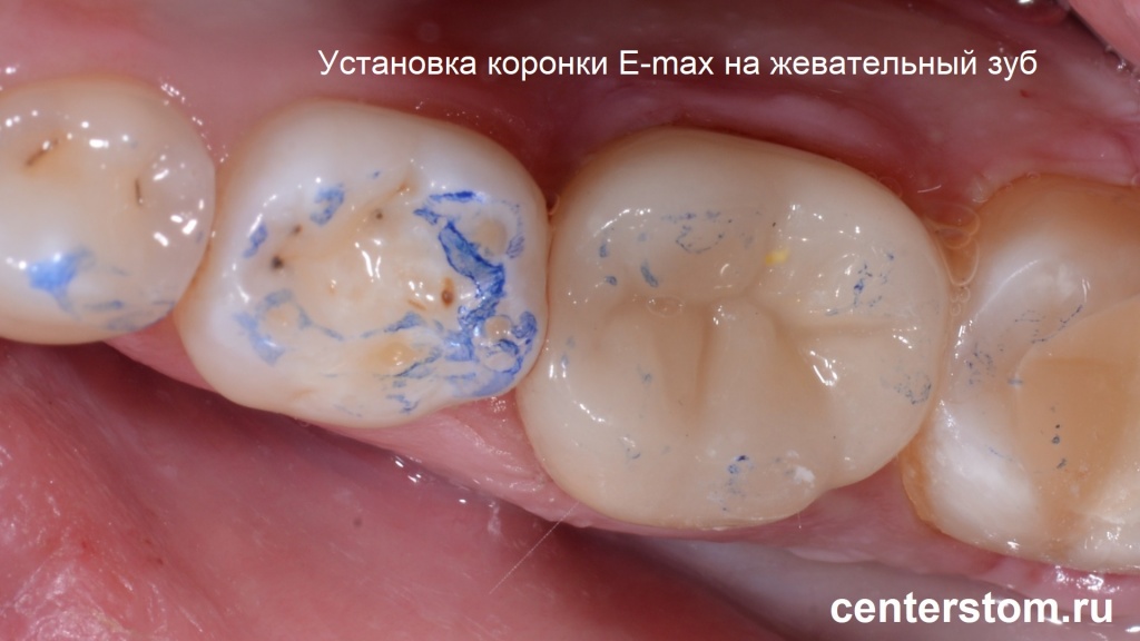 Установка коронки E-max на жевательный зуб