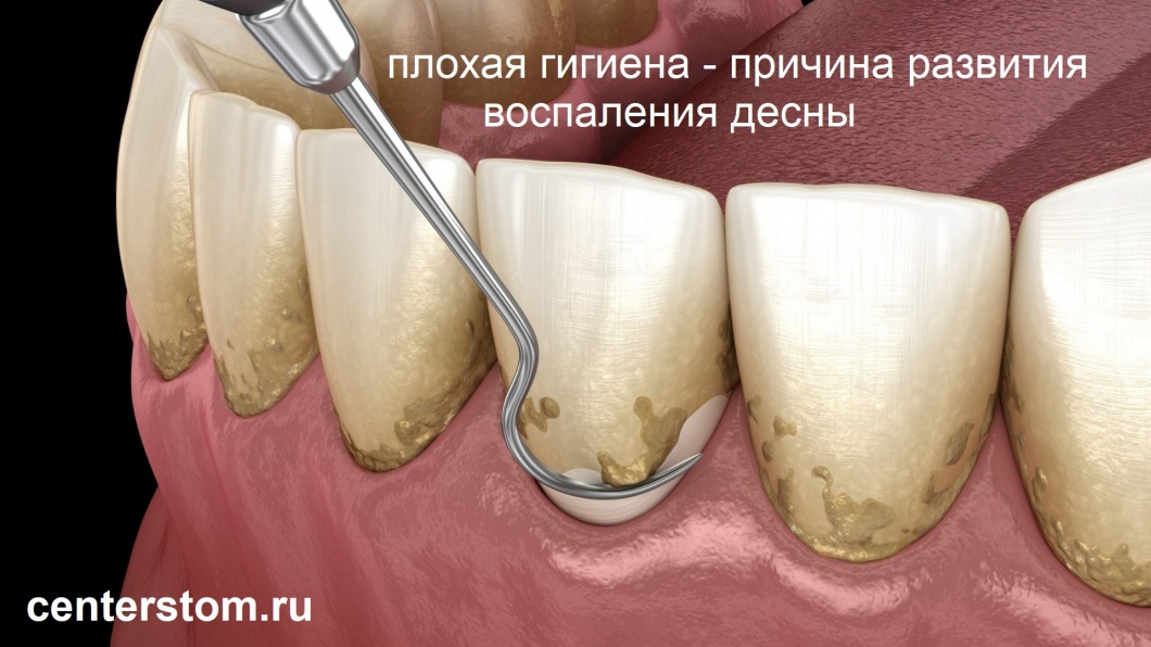 Частая причина воспаления десен - плохая гигиена зубов