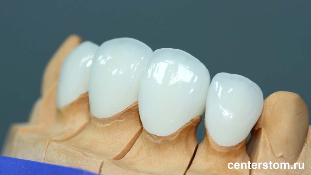 Примерка керамическиих коонок на передние зубы на модели