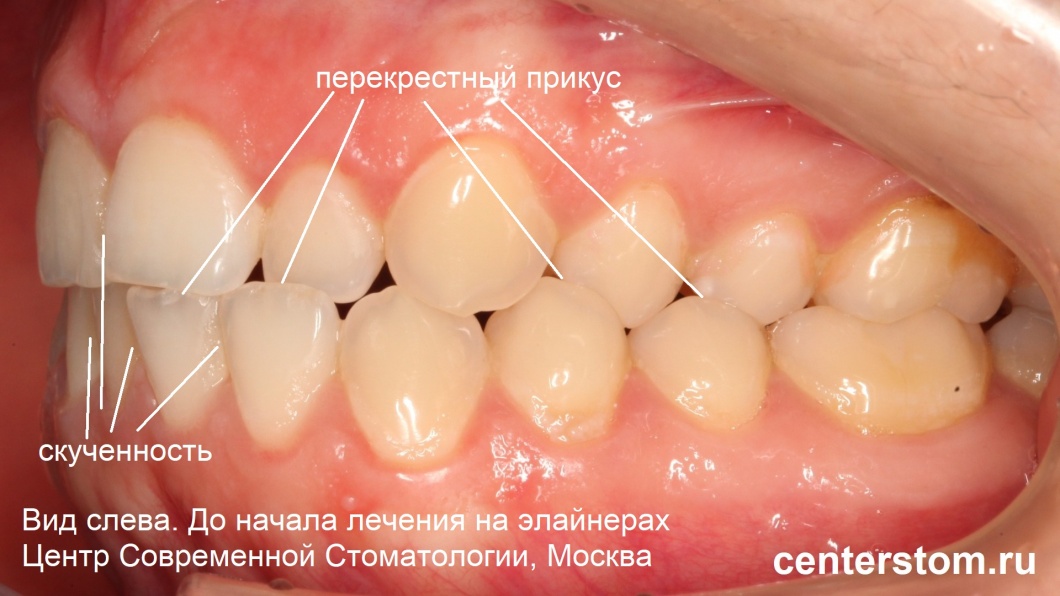 Вид зубов слева ДО начала лечения на элайнерах. Диагноз - перекрестный прикус, скученность резцов
