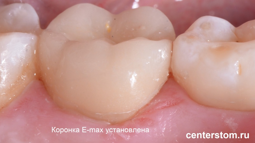 Коронка E-max установлена на жевательный зуб. Центр Современной Стоматологии, Москва