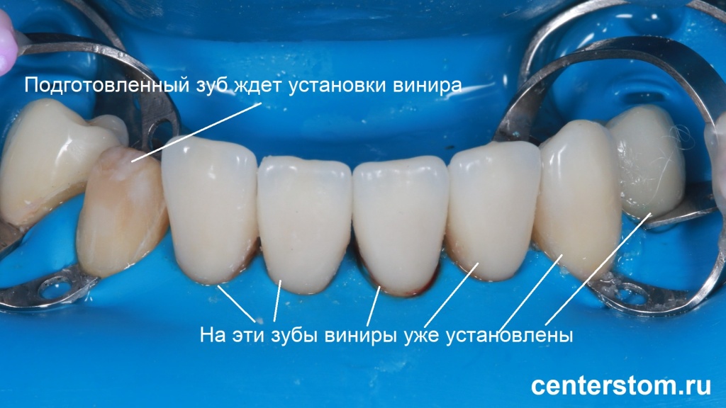 Процесс фиксации виниров на зубах нижней челюсти. Центр Современной Стоматологии на Бауманской, Москва