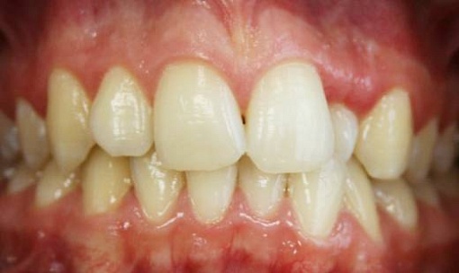 Перекрестное смыкание зубов в области резца верхней челюсти