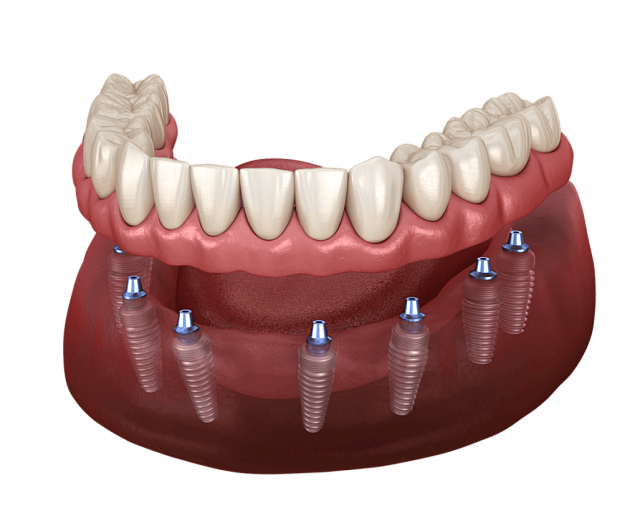 All-on-8 имплантация и протезирование зубов