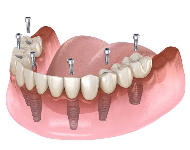 All-on-6 имплантация и протезирование зубов